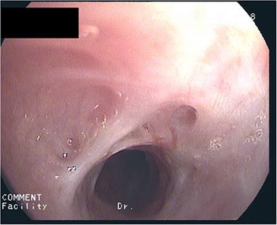 Case report: Idiopathic subglottic stenosis in a girl; successful treatment with macrolides